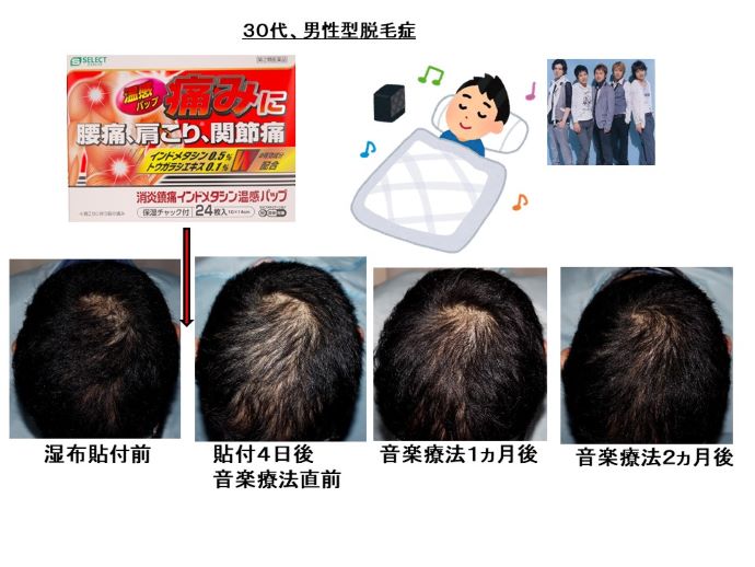 円形脱毛症　病院